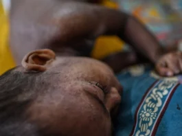 Measles Outbreak Kills 1,000 Children